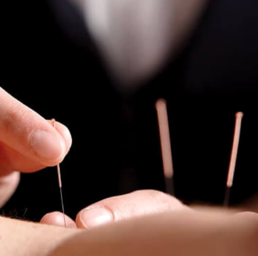 O que é acupuntura?