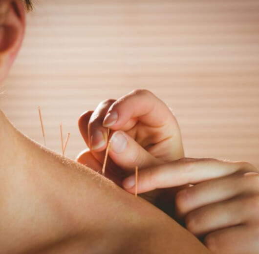 Benefícios da acupuntura: