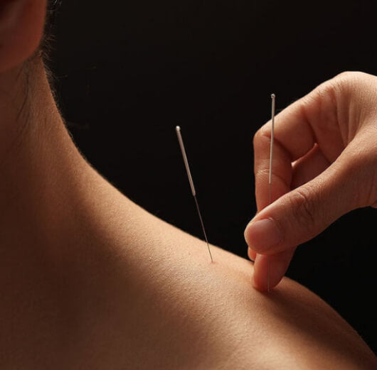 Indicações da acupuntura: