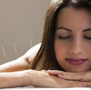mulher recebendo acupuntura nas costas e braços